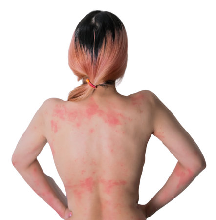 Woman with Skin allergy all over her body showing her back part with red rash and skin infection.の写真素材