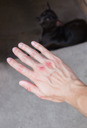 Fresh wound and blood on the right hand from a bite Dog.の写真素材