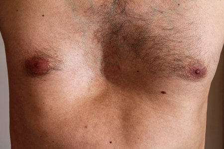 Chest deformity, birth defect. Strong deformity. Physical disability. pectus excavatus