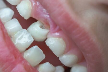 Baby tooth, close-up of the tooth that falls macro shot.の写真素材
