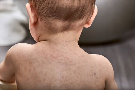 Photo of roseola rash a viral rash on - ID:1-149361286 - Royalty Free ...