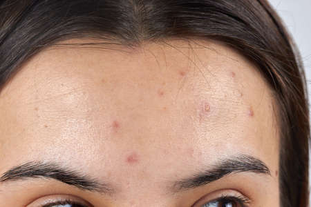 face close-up of redness and pimples skin cleansing.の写真素材
