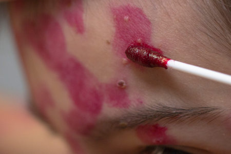 Treating the skin rash with a cotton swab. chickenpox virus. Skin rash and blisters on the body....