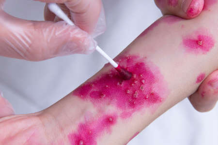 Treating the skin rash with a cotton swab. chickenpox virus. Skin rash and blisters on the body. Treatment concept for symptoms of Varicella zoster virus, fucorcinum treatment, antiseptic and antifungal.の写真素材