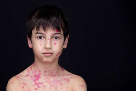 Close-up of the bodies of children with chickenpox and blackheads. Inflammation of the skin. The concept of health care.の写真素材