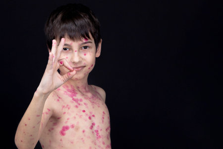 A boy aged 8 years old is gesturing OK. Chickenpox virus. Skin rash in a child. Varicella pox