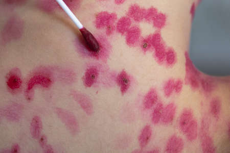 Treating the skin rash with a cotton swab. chickenpox virus. Skin rash and blisters on the body. Treatment concept for symptoms of Varicella zoster virus, fucorcinum treatment, antiseptic and antifungal.の写真素材