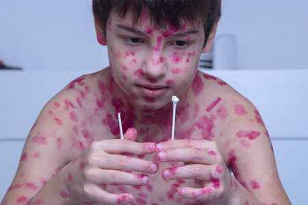 Treating the skin rash with a cotton swab. chickenpox virus. Skin rash and blisters on the body. Treatment concept for symptoms of Varicella zoster virus, fucorcinum treatment, antiseptic and antifungal.の写真素材