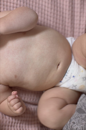 Roseola of the course of the disease in the baby, rash on the skin, the baby is capricious and...