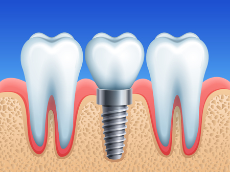 Vector illustration - dental implant and teethのイラスト素材