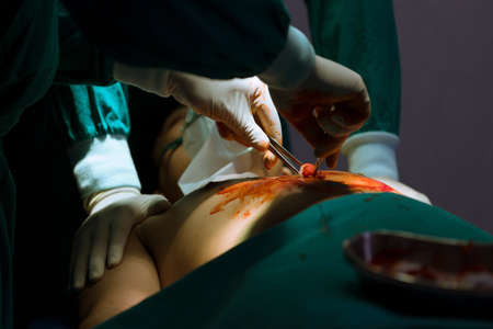 The surgeon's team with surgical tools making thoracic surgery in the operation room in critically ill cases.の写真素材