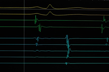 heart cardiodiagram tracing on monitor device
