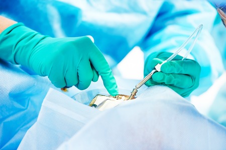 ophthalmology operation. Surgeon's hands in gloves performing laser eye vision correction correctionの写真素材