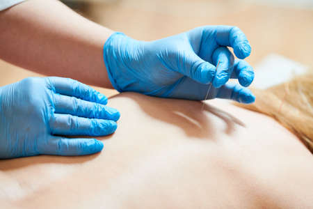 Acupuncture medical treatment. Alternative medicineの写真素材