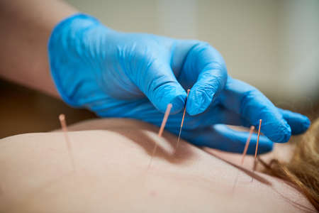 Acupuncture medical treatment. Alternative medicineの写真素材