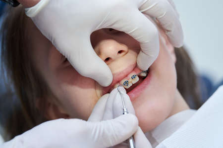 Braces for child teeth correction. Installation and maintenaceの写真素材