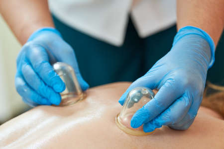 Physical cupping therapy. Doctor performing massage on human body with plastic cupsの写真素材