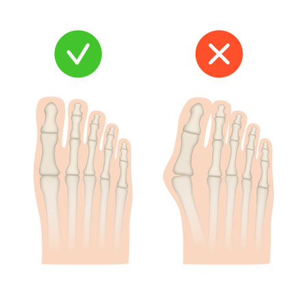 Hallux valgus. Valgus deformity of the big toe joint. Vector illustration.のイラスト素材