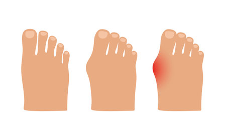 Hallux valgus. Valgus deformity of the big toe joint. Vector illustration.のイラスト素材