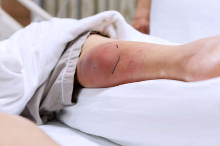 Old woman get injured from a horse kick her leg. Calf leg of person have mark the prepare for...