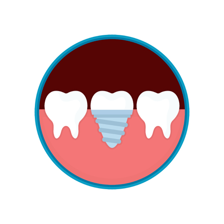 Dental implant in mouth with replacement crown for dentistry concept design. Vector modern flat style cartoon illustration icon. Isolated on white backgroundのイラスト素材