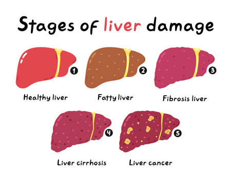 Stages of liver damage infographic. Vector hand drawn cartoon illustration icon. Isolated on white background. Human sick unhealthy Liver organ, cartoon infographic poster conceptのイラスト素材