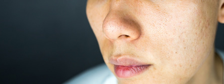 Acne pimples scar on face skin issues, close upの写真素材