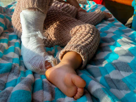 Child with bandage on leg heel fracture. Broken right foot, bone, calf, ankle, leg in plaster, splint of toddler. Little boi sleeping on a blue blanket. Human healthcare and medicine conceptの写真素材