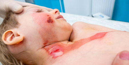 medical procedure dressing a boy with a first-degree burn from boiling water on his face, neck and chestの写真素材