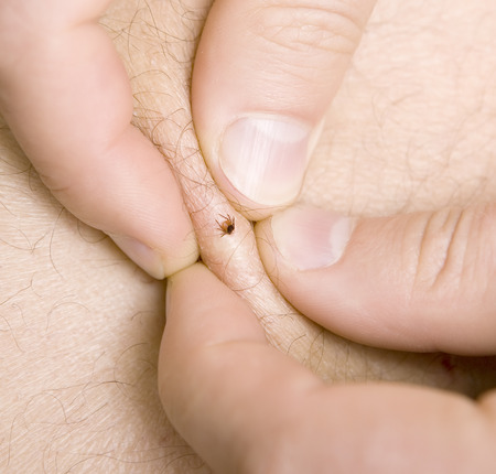 correct removing a tick from skin of patientの写真素材