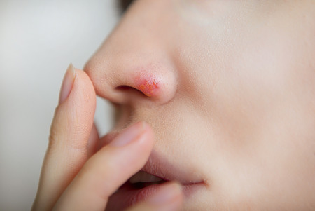 Herpes on the nose - Pretty young caucasian woman with herpes her on nose, close-up. Human Virus