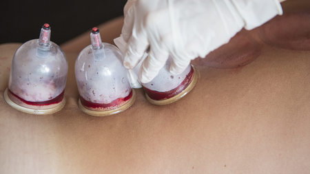 Traditional Chinese Medicine – Cupping process. Hijamah Cups on back of female patient in...