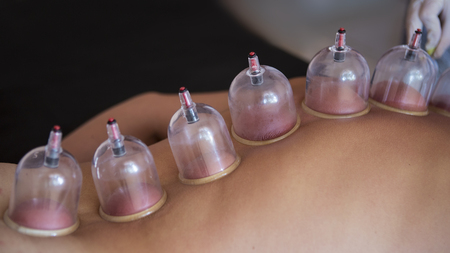 Traditional Chinese Medicine  Cupping process. Hijamah Cups on back of female patient in Acupuncture therapy. Chinese Traditional  treatment. Medical cupping therapy equipment.の写真素材