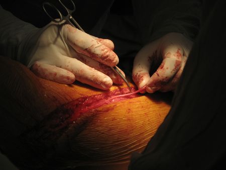 A surgeon performs vein separation for coronary artery bypass surgery