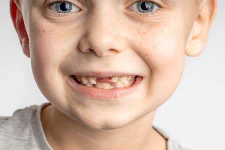 close-up of a child's face with lost front teethの写真素材