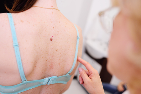 woman doctor examines the patients mole for neoplasms. Melanoma preventionの写真素材