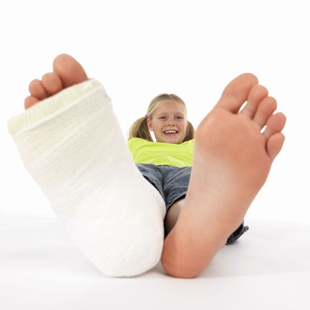 girl with a broken leg (close-up of feet, one with a plaster bandage)の写真素材