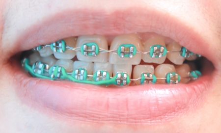 teeth with bracesの写真素材