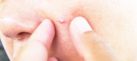 Human face with scar and acne skinの写真素材