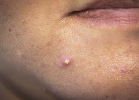 acne is inflammation on a human chinの写真素材