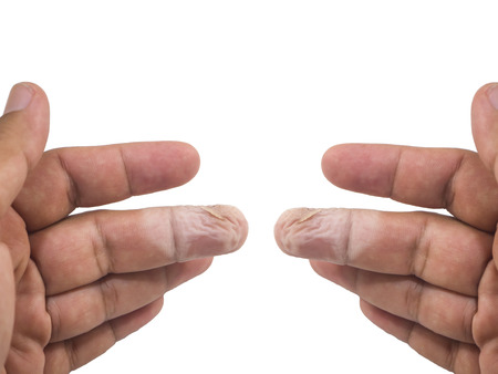 Small wounds with fingers and paleの写真素材