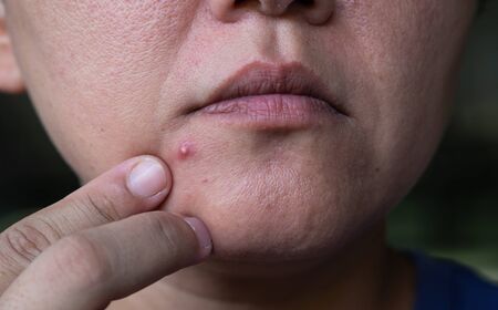 Squeezing the infected pustules acne on the faceの写真素材