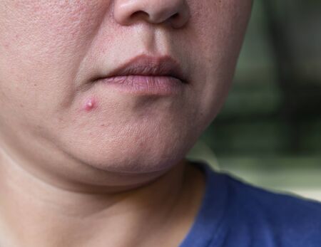 Close up photo of pustules acne skinの写真素材