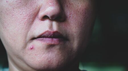 Close up photo of pustules acne skinの写真素材