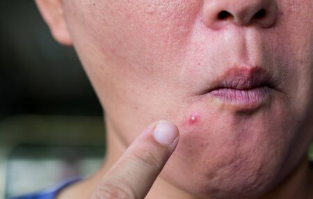 Squeezing the infected pustules acne on the faceの写真素材