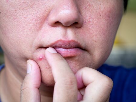 Squeezing the infected pustules acne on the faceの写真素材