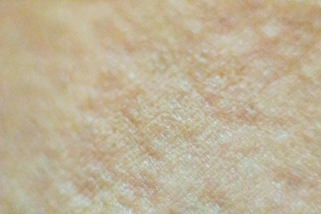Close up view of cold urticaria allergic rash. Symptoms of itchy urticaria.