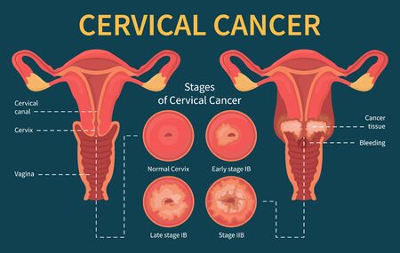 Cervical cancer infographic. Stage of disease. Female reproductive system. Progress of the spread of infected cells due to the virus. Dysplasia and ectropion.のイラスト素材