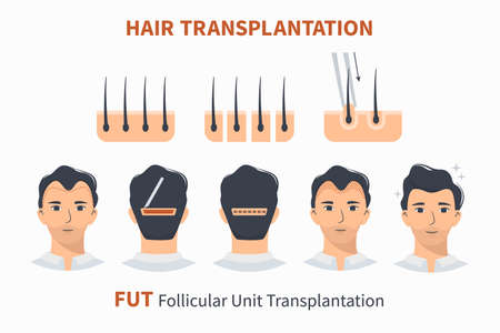 Stages of hair transplantation FUT Follicular Unit. Treatment surgery of baldness, alopecia, mens hair loss. Vector medical infographics, a male head scalp. Strip, graft machine.のイラスト素材