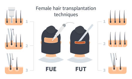 Female hair transplantation FUE and FUT infographicのイラスト素材